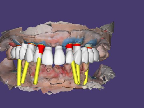 Implants planned digitally